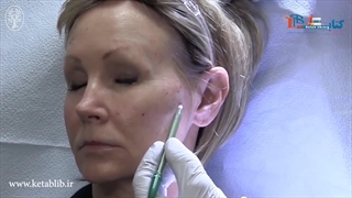 نمونه کیفیت ویدیوهای کتاب مناطق خطرناک صورت : امنیت در جراحی،تزریق فیلر و دستگاه های غیر تهاجمی ویرایش اول - 2020