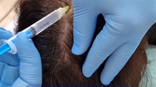 مزوتراپی مو فردیس