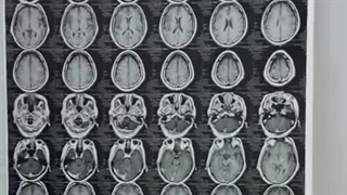 ناپدید شدن توده مغزی فقط در 10 روز