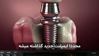 دلایل شکست ایمپلنت