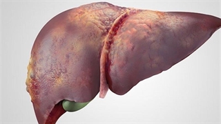 راه اصلی درمان کبد چرب