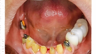 روکش کردن دندان در دندانپزشکی دکتر علی ممتازی