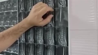 جراحی دیسک کمر