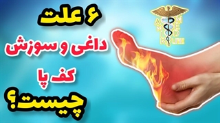 ۶ علت اصلی و اساسی سوزش و گزگز و داغی کف پا چیست؟