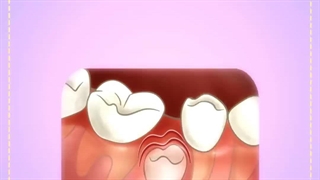 دکتر لیلی صدری دندان پزشک کودکان ساری پوسیدگی دندان