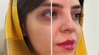 فیلر زیر چشم و گونه