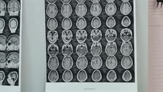 متاستاز مغز