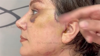 جراحی کامل لیفت صورت و عمل زیبایی بینی