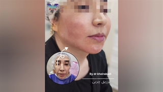 نمونه‌ای از تزریق چربی به صورت (4)