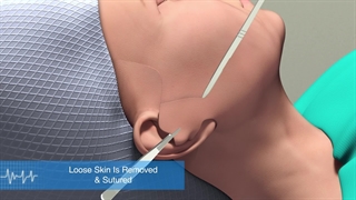 چگونگی انجام لیفت صورت