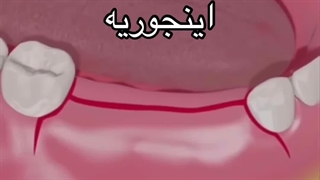 نحوه کاشت ایمپلنت دندان در کرج ( دندانپزشکی شبانه روزی )