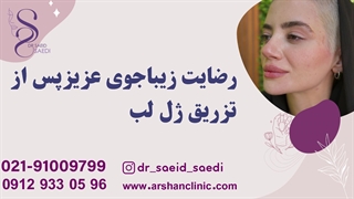 رضایت زیباجوی عزیز پس از تزریق ژل لب