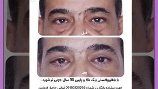 از بین بردن پف زیر چشم فوری لیفت ابرو