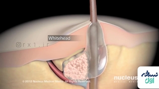 آشنایی با انواع آکنه - داروخانه آنلاین نسخه اول - داروخانه اینترنتی نسخه اول جراحی لثه