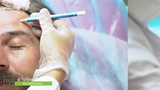 تزریق بوتاکس در کلینیک سلامت ایده آل