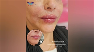 نمونه‌ای از تزریق فیلر لب (6)