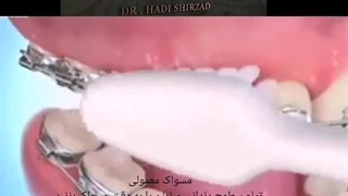 دکتر هادی شیرزاد پر کردن دندان