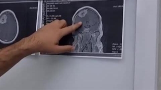 درمان تومور بسیار بزرگ در ناحیه مغزی