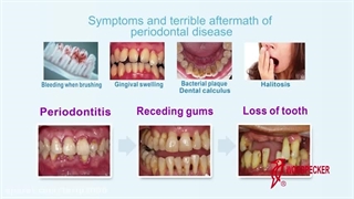 جرم گیری دندان بوسیله ابزار آلتراسونیک
