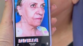 جراحی لیفت صورت به روش دیپ پلین (لیفت عمقی صورت)