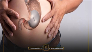 بوتاکس معده چیست؟ | هزینه و عوارض بوتاکس معده