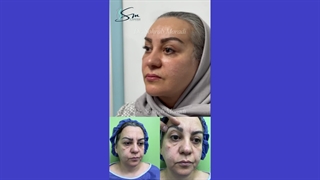 جراحی لیفت صورت به روش دیپ پلین بروزترین روش دنیا