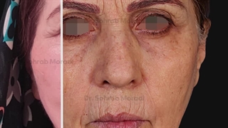 شد الوجه والرقبة و جراحة الجفن السفلی