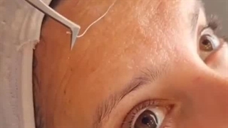 لیف پیشانی با نخ