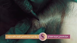 اسکالپ سر در مرکز تخصصی مریم حمزه ای