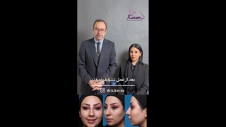 رضایت زیباجو از عمل زیبایی بینی مدل نیمه فانتزی