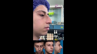 قبل و بلافاصله پس از عمل زیبایی بینی همراه با ورم زیاد