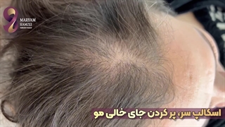 اسکالپ سر در مرکز آرایش دائم مریم حمزه ای