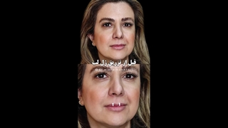 تزریق فیلر لب، گپ چانه و بوتاکس