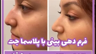 فرم دهی بینی با پلاسماجت چیست؟ درمان سلولیت