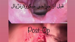 #دکتر_کاظمی_بهترین_جراح_حنجره