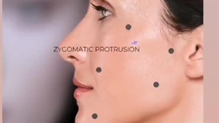 آموزش نقاط تزریق بوتاکس