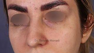 جراحة التجمیل الأنف