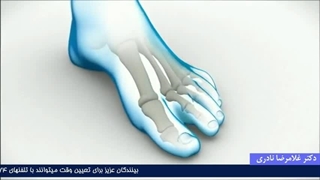 هالوکس والگوس چیست و چگونه درمان می شود؟