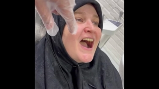 فیلم گذاشتن دو واحد دندان مصنوعی فیلیپر بالا