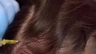 هزینه پی آر پی موی سر