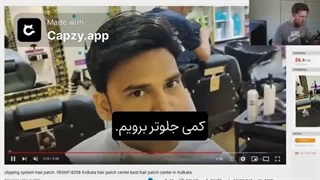 اشتباهات رایج در انجام سیستم های جایگزین مو ( پروتز مو )