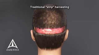 جدیدترین روش های کاشت مو