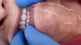 فیلم گذاشتن دندان مصنوعی ثابت