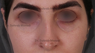 عملیة تجمیل الأنف