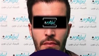 قبل و بعد از کاشت مو