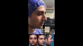 قبل و بلافاصله پس از عمل زیبایی بینی همراه با ورم زیاد