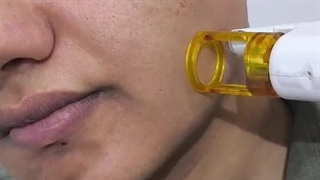 لیزر موهای زائد مردان در فردیس