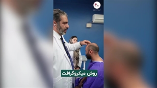 کاشت مو برای افراد طاس: راهکار تضمینی بدون نیاز به بانک مو