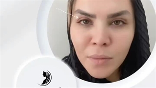 فیلم اندولیفت زیر چشم