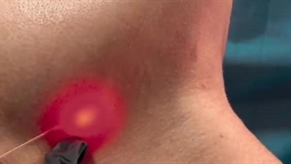 فیلم اندولیفت پیشانی